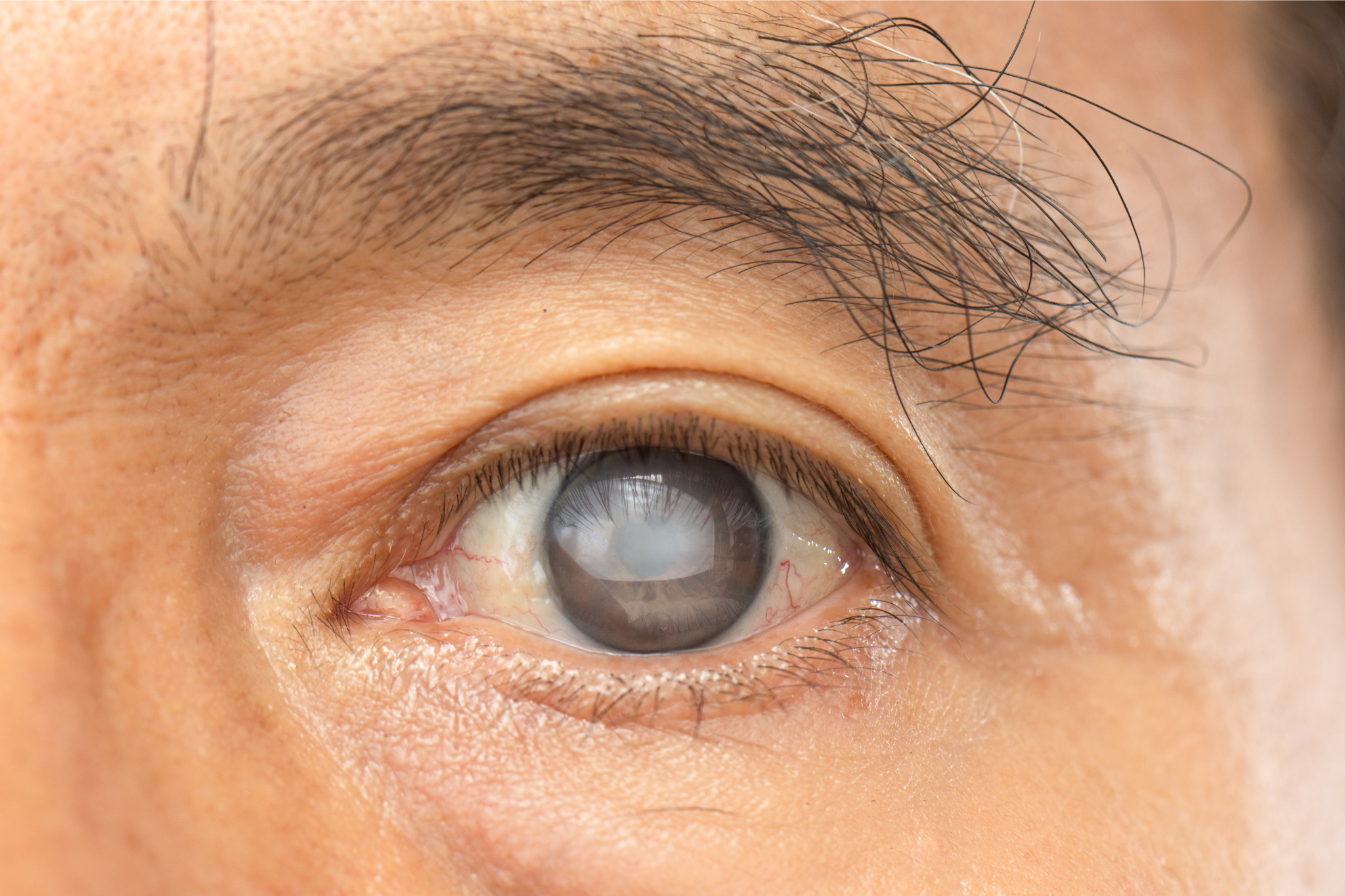 Nova lei garante acompanhamento oftalmológico a pacientes após cirurgia de catarata em Campo Belo